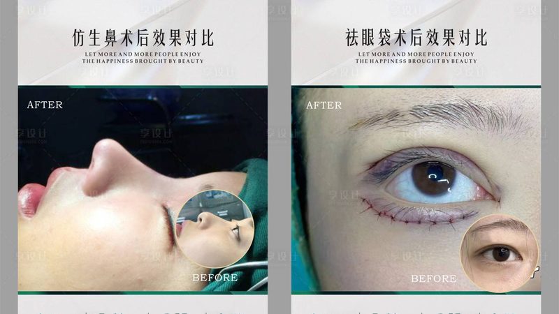 玻尿酸去法令纹，揭秘价格背后的秘密**