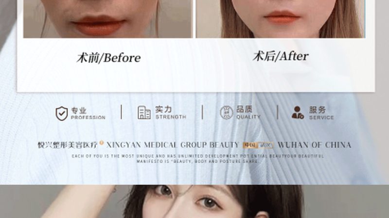 肉毒素VS玻尿酸：揭秘微整形中的双剑客