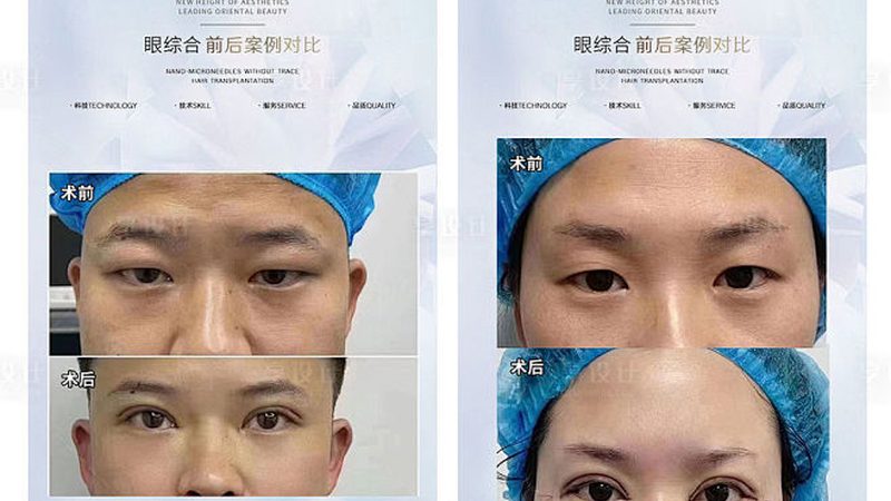 医用光子嫩肤机：揭秘十大品牌背后的技术奥秘**
