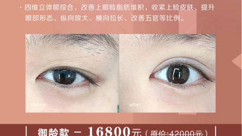 儿童斜视肉毒素治疗：注意事项与正确认知**