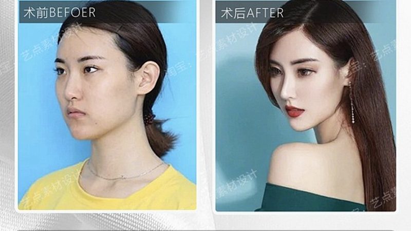 国产光子嫩肤仪：揭秘其原理与选购要点
