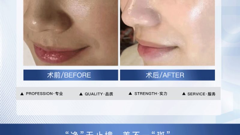 肉毒素除皱与瘦脸：风险对比解析