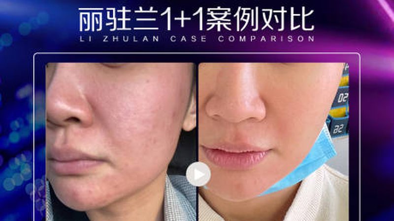 激光美容主要分为以下几类：
