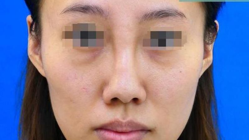 玻尿酸家族揭秘：大分子与小分子价格差异背后的秘密